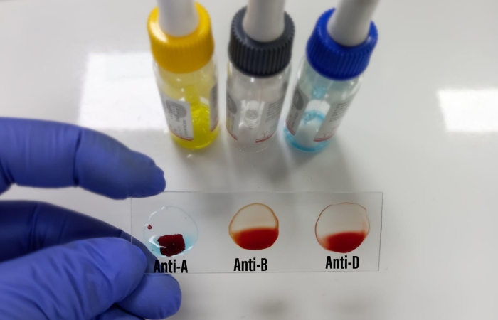 Rare Blood Group: Mm-Negative-Rare-Blood-Group-Found-In-Rajkot-Man-11th-Such-Case-Worldwide.